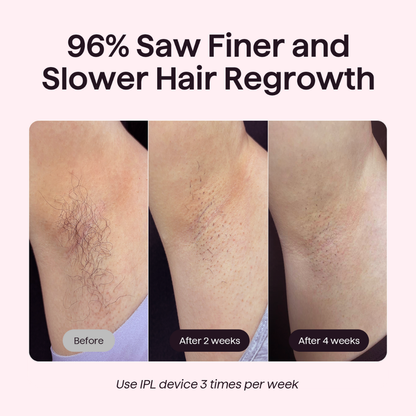 Before and after hair regrowth treatment showing finer and slower hair growth on a person's leg.